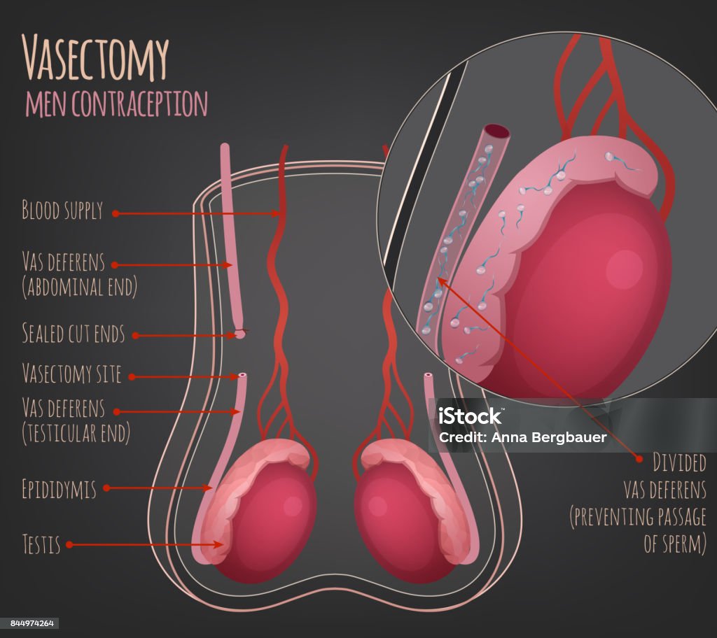 Vasectomy in NZ: What You Need to Know Before the Procedure