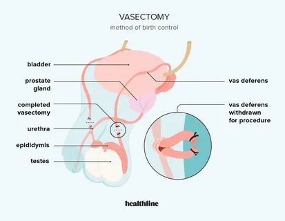 Vasectomy Cost Auckland Guide: Finding Quality Care at the Right Price